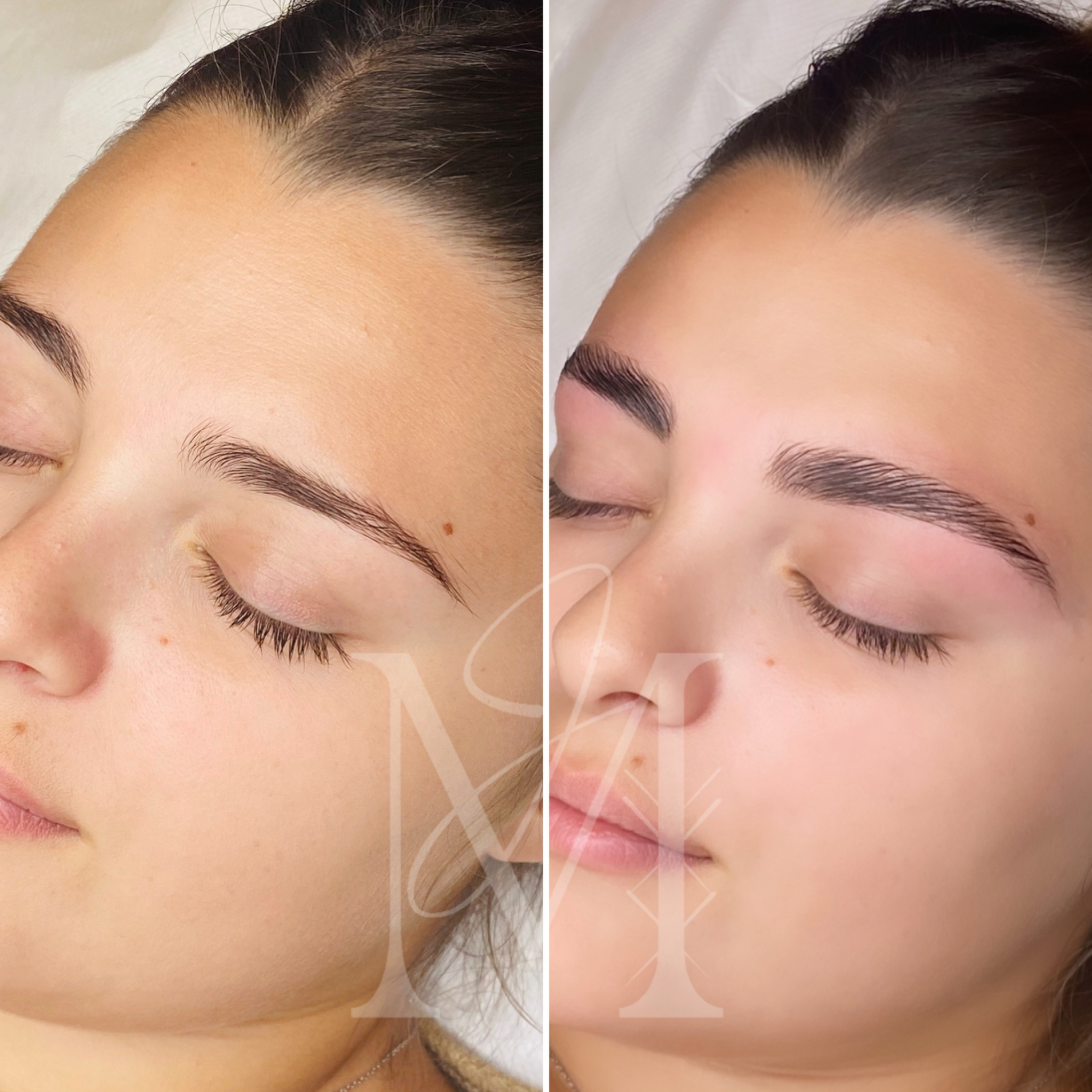 Brow Lift - 2 